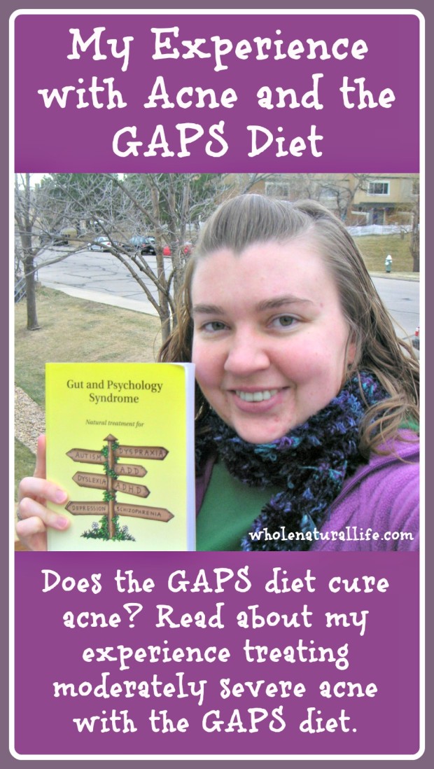 Does the GAPS diet cure acne? Click here to read about my experience treating moderately severe acne with the GAPS diet. 